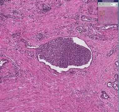 Histopathology Prostate--Acute ...