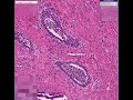 Histopathology Prostate--Acute prostatitis Histopathology Prostate--Acute prostatitis