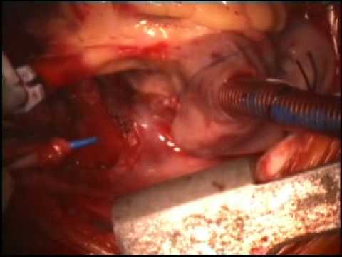 See video