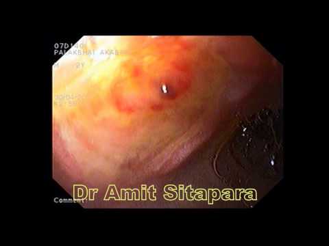 how to diagnosis a gi bleed