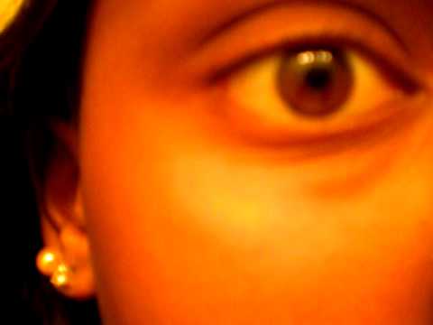 how to treat eye twitching