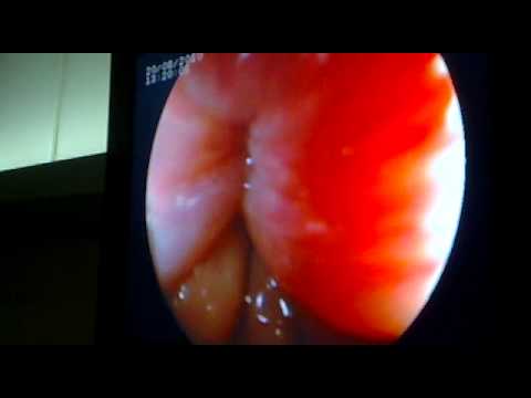 Retoscopia rígida - Retossigmoidoscopia ou Endoscopia baixa, utilizada neste caso como exame diagnóstico de Hemorróidas. Observa-se a mucosa sigmoidea normal, o recto e o Anus. ...