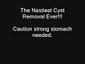 Best Home Cyst Removal Ever
