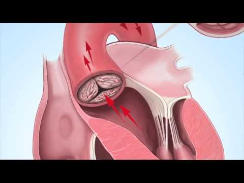 how to treat aortic stenosis