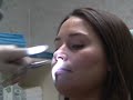 Stopping Nosebleeds by Nasal Cauterization