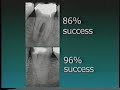 Estudos de Prognóstico – Endodontia