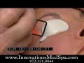 SmartXide Dot Therapy Live Procedure