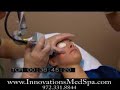SmartXide Dot Therapy Live Procedure