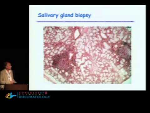 how to treat sjogren's syndrome