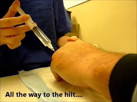 how to administer lidocaine injection
