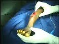 Rail Fixator in Aseptic Nonunion with deformity - Part 1