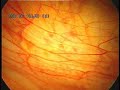 Autofluorescent Endometriosis 2