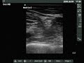 Ultrasound views of the sciatic nerve (popliteal fossa) Ultrasound views of the sciatic nerve (popliteal fossa)