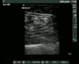 Ultrasound views of the sciatic nerve (popliteal fossa)