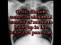 What is Cystic Fibrosis?