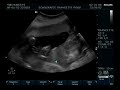 ultrasound-20-weeks-pregnant.html