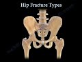 Hip Fractures, Types  and fixation - Everything You Need To Know - Dr. Nabil Ebraheim