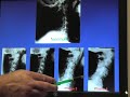 Arthritis cause and reversal naturally with Chiropractic  Osteoarthritis Chiropractic