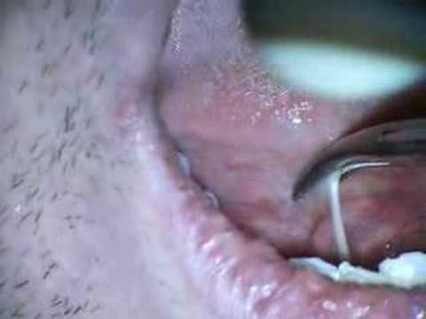 Lingual Frenectomy with Erbium Laser