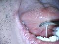 Lingual Frenectomy with Erbium Laser