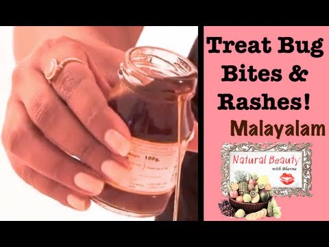 how to treat swelling from a mosquito bite