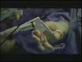 First Midwest SILS Techniqe Uterus Removal Performed