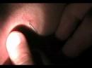 the sist on my neck exploding needle ...