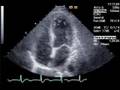 SAH-Induced Cardiomyopathy - During