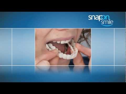 how to get snap on smile