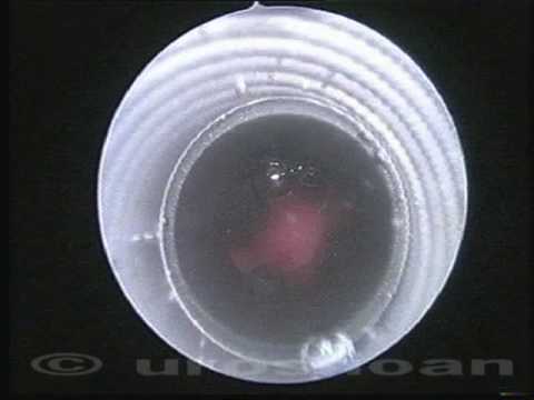 prostatic