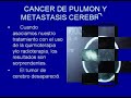 CANCER. TRATAMIENTO Y CURACION. CANCER. TRATAMIENTO Y CURACION.