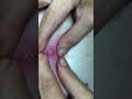Biggest pimple ever