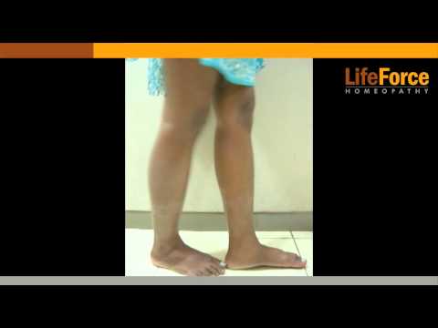 how to cure ichthyosis