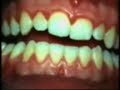 Periodontitis Disease Periodontitis Disease