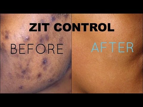 how to treat zit inside nose