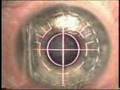 LASIK 2001 LASIK 2001