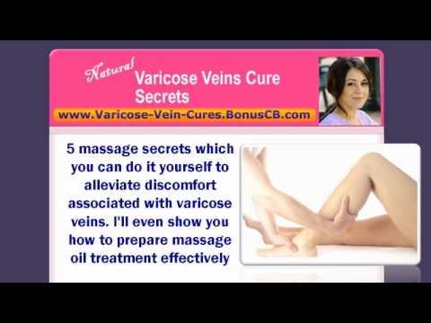 how to relieve varicose veins in pregnancy