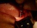 Mini implantes 2