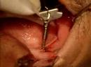 Mini-implantes-2