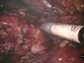 Robotic-Assisted Partial Nephrectomy Robotic-Assisted Partial Nephrectomy