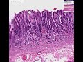 histopathology-stomachatrophic-gastritis.html