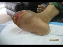 how to reduce diabetic !! with diet and nutrition