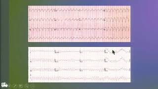 Prehospital basic life threatening ECG rhythm - 용인다보스병원 박종대 선생님