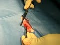 Neuter 2, Castration 2