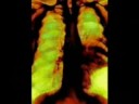 Mesothelioma AIDS - Living and Coping
