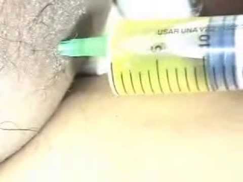 how to drain hydrocele