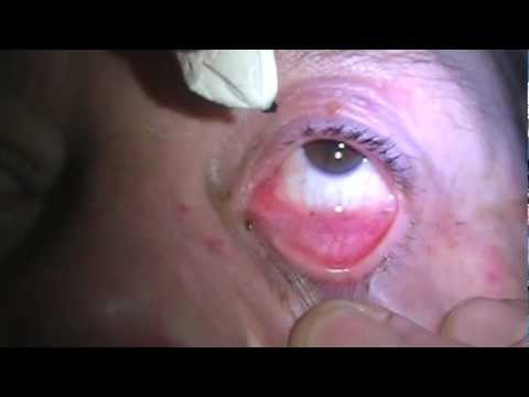 how to cure periodontal disease