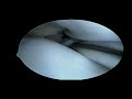 Partial medial meniscectomy-Part 2