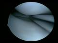 Partial medial meniscectomy-Part 2