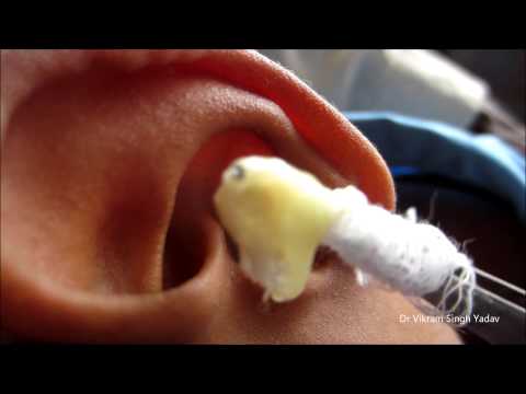 how to drain pus from ear